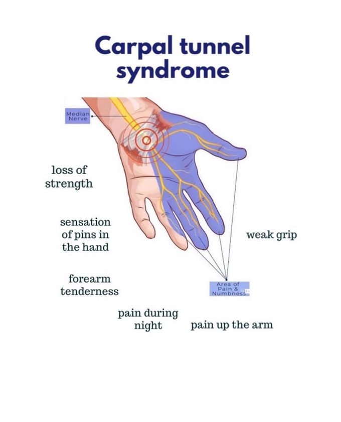 Carpal tunnel syndrome