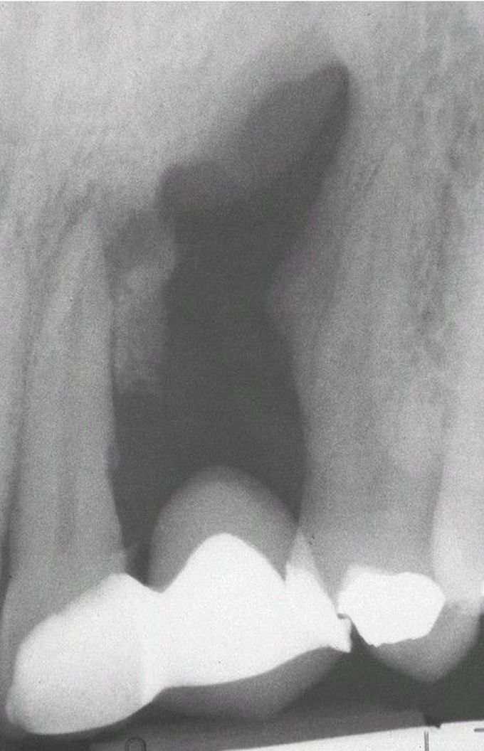 Periapical Fibrous Scar.