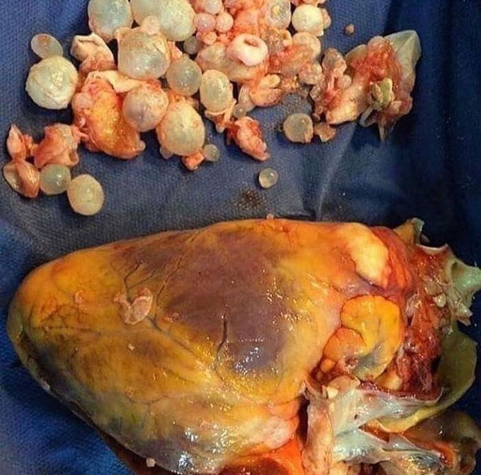 Hydatid cyst of the heart