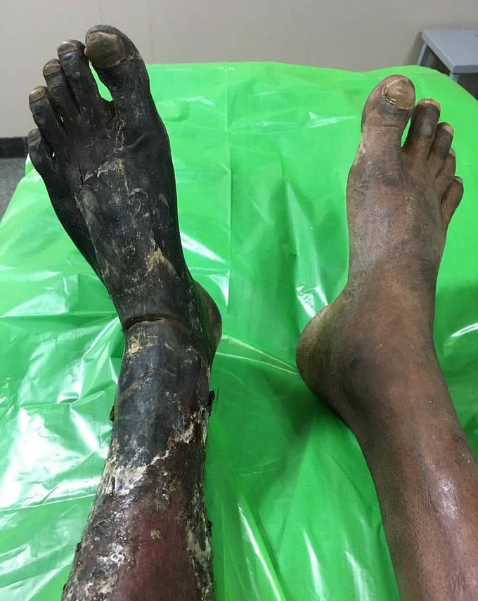 Patient suffering from dry gangrene of his left foot.  