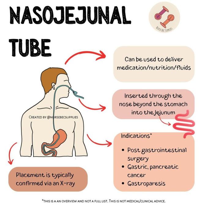 Nasojejunal Tube
