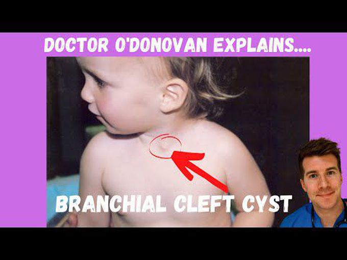Branchial Cleft Cyst