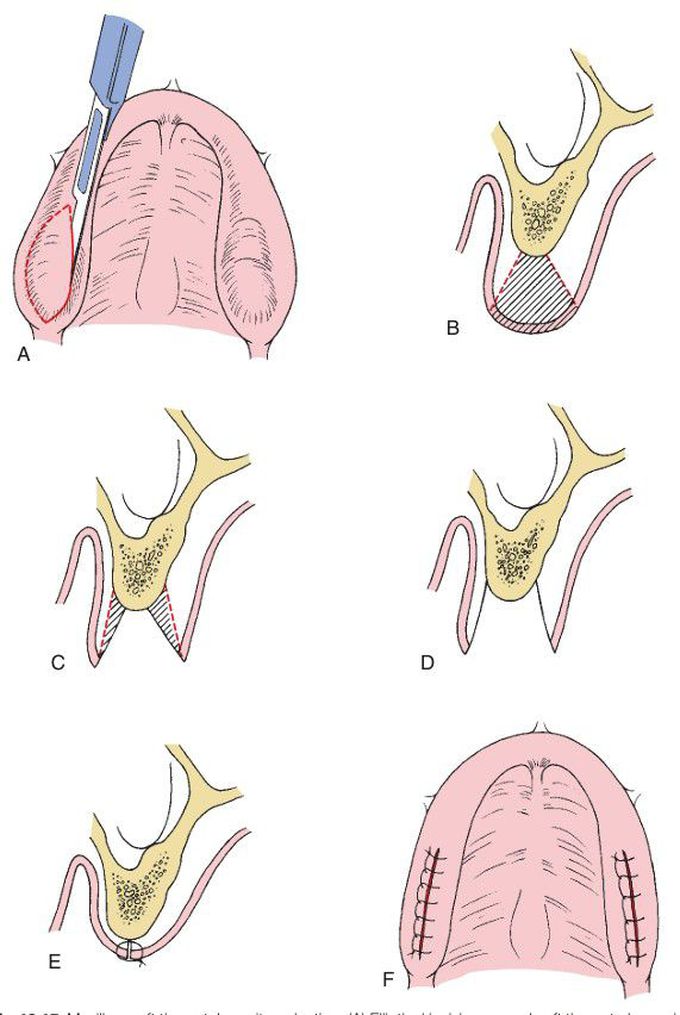 Maxillary soft tissue tuberosity reduction