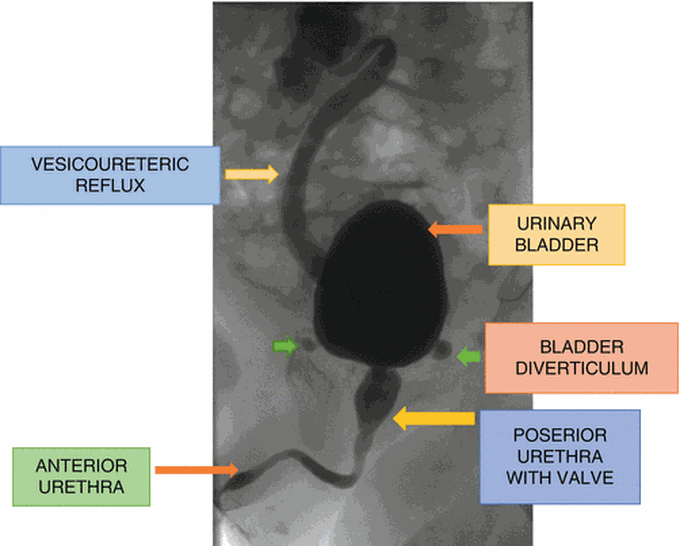 Posterior Urethral Valve Medizzy