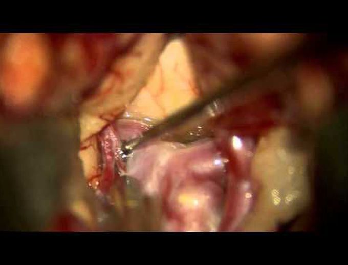 Combined interhemispheric and pterional approach for ACOM and left MCA aneurysms