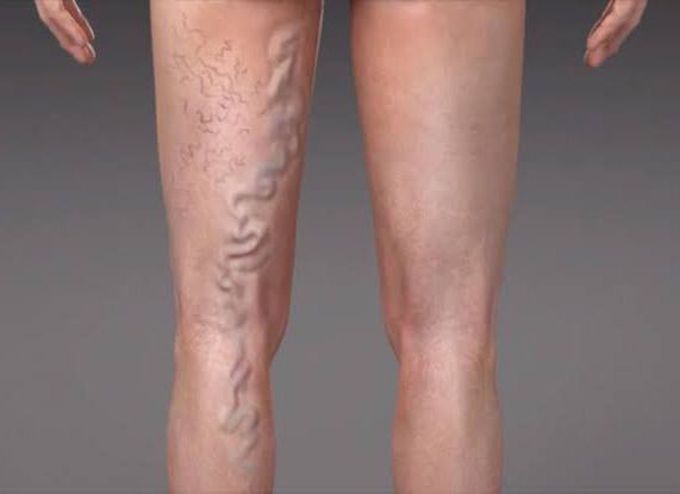Varicose veins