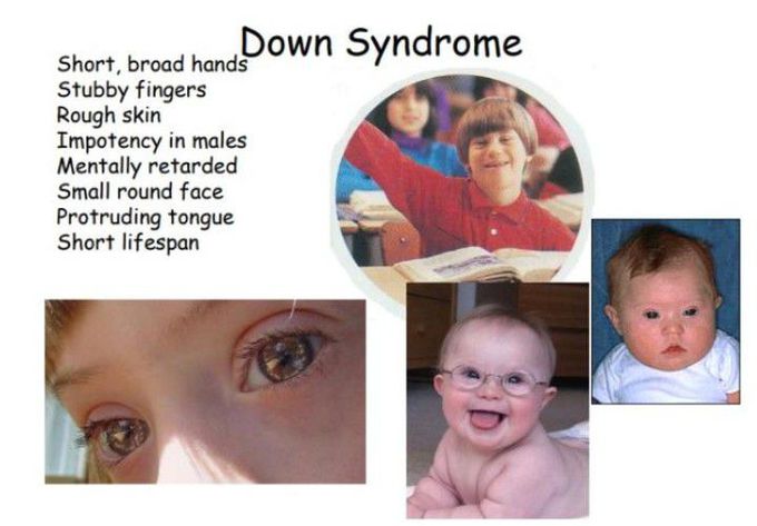 Clinical features of Down syndrome