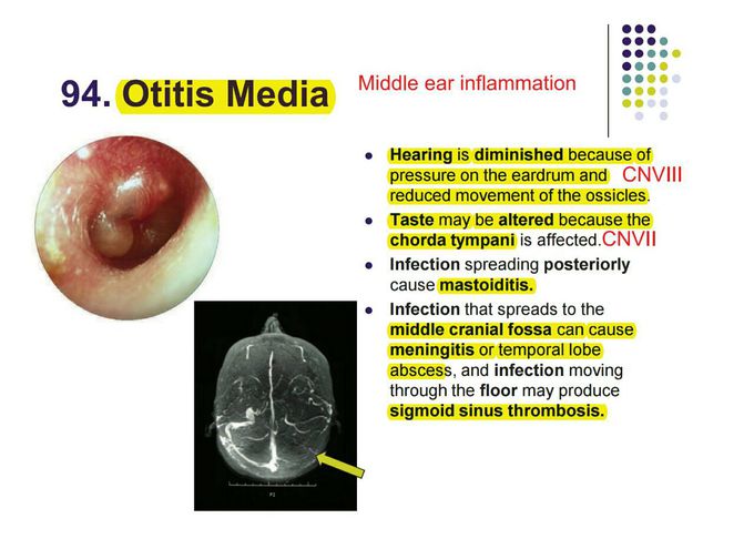 Otitis media