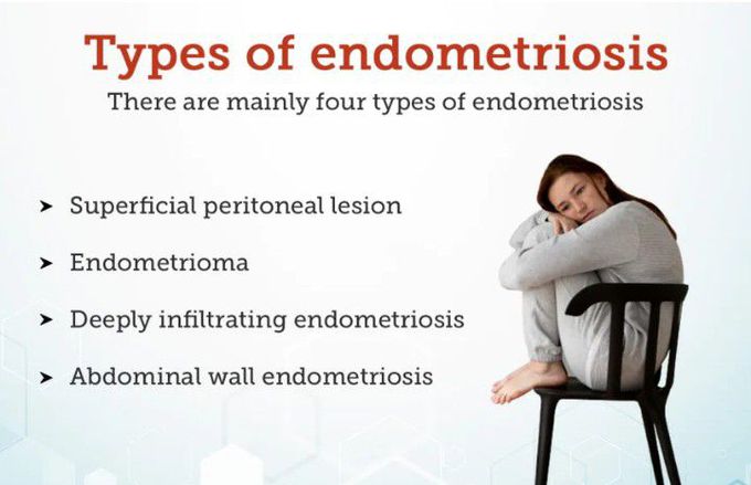 Types of Endometriosis
