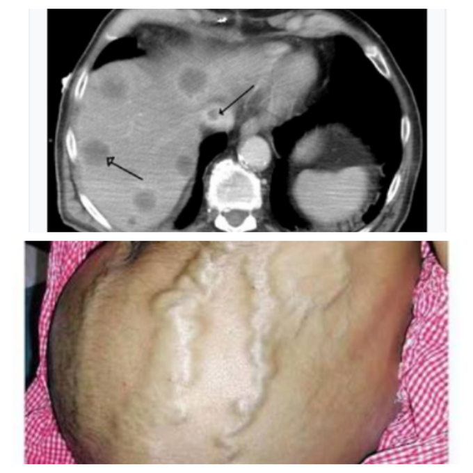 Budd chiari syndrome