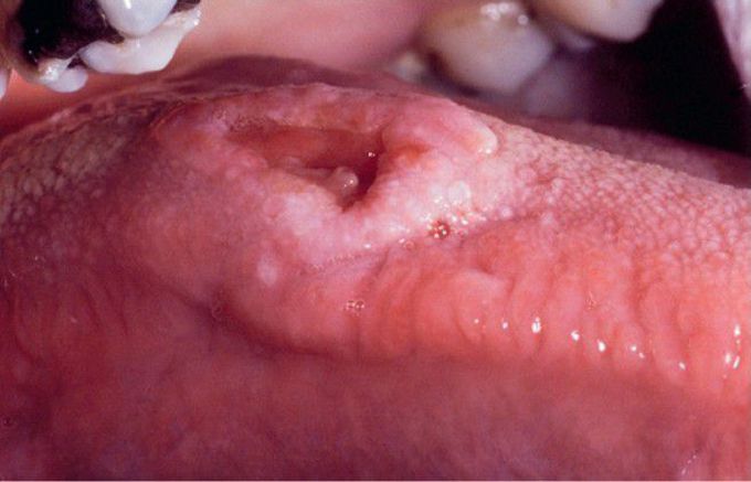 HIV-associated Histoplasmosis