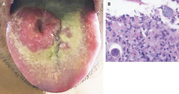 Disseminated Coccidioidomycosis