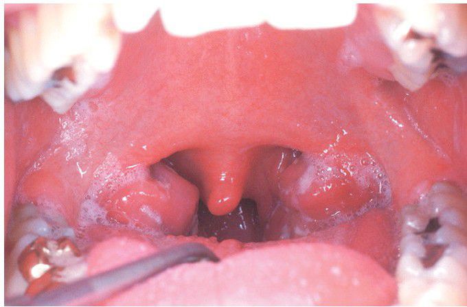 Infectious Mononucleosis