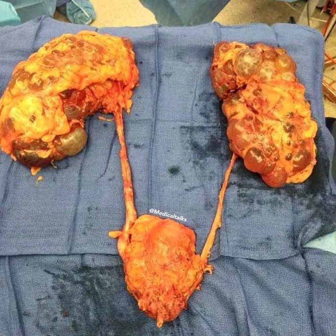 The urinary system removed in its whole!! 