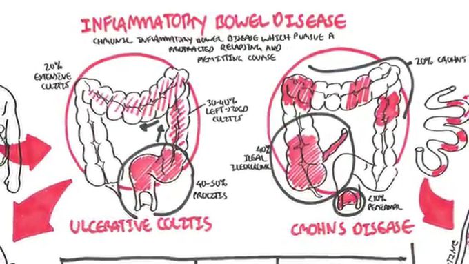 Crohns disease and Ulcerative colitis