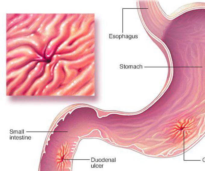 Cause of Helicobacter pylori