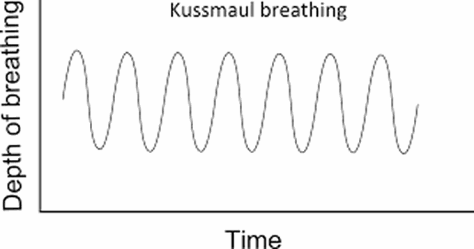 Kussmaul breathing