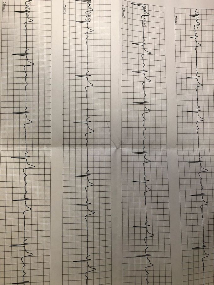 ECG Troubles