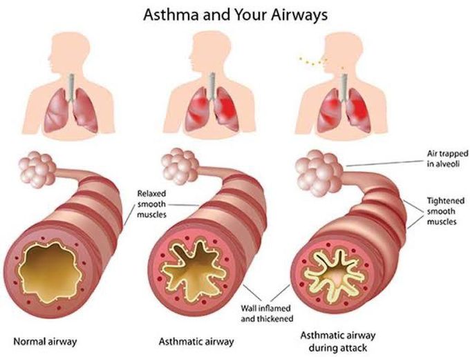 Asthmatic airway