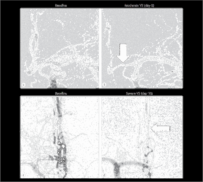 Preventive Effect of Clazosentan against Cerebral Vasospasm after Clipping Surgery for Aneurysmal Subarachnoid Hemorrhage in Japanese and Korean Patients