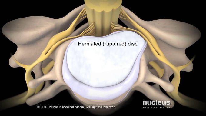 Anterior Cervical Discectomy and Fusion