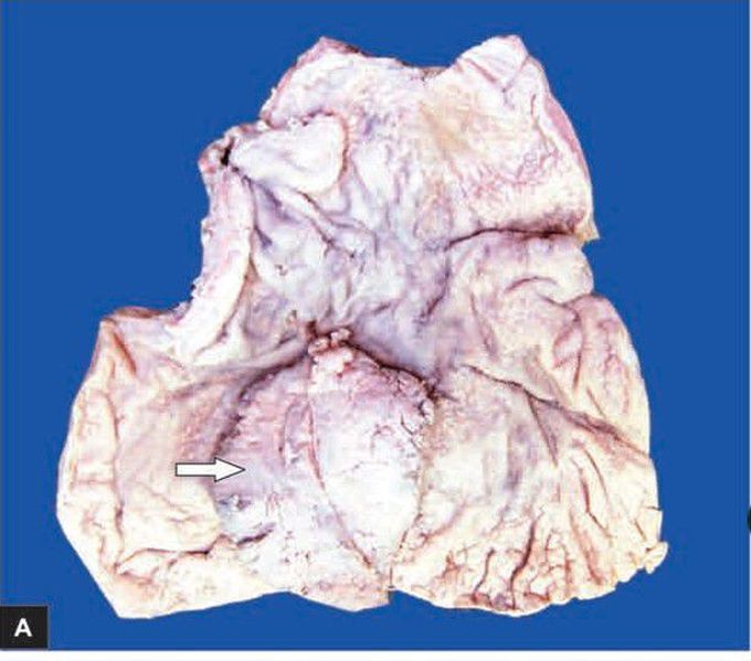 Ulcerative carcinoma stomach