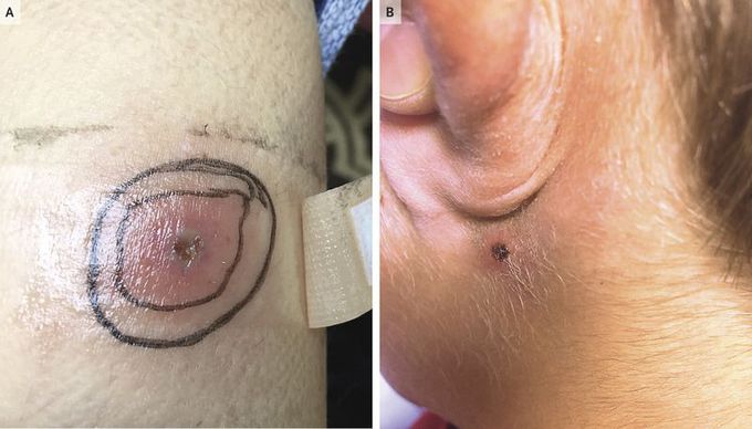 African Tick-Bite Fever