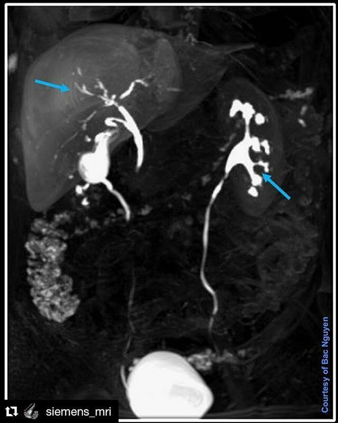 Liver Spesifict Contrast Agent Primovist/Eovist