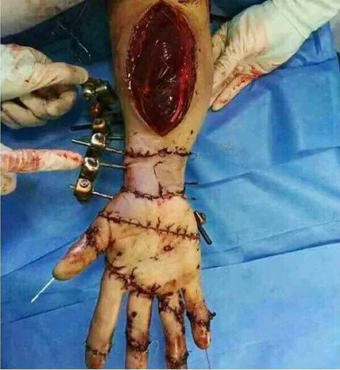 Reemplazando las partes de una mano cortada mediante fijación externa con clavos, tornillos y clavos intramedulares múltiples para las fracturas proximales de la falange.