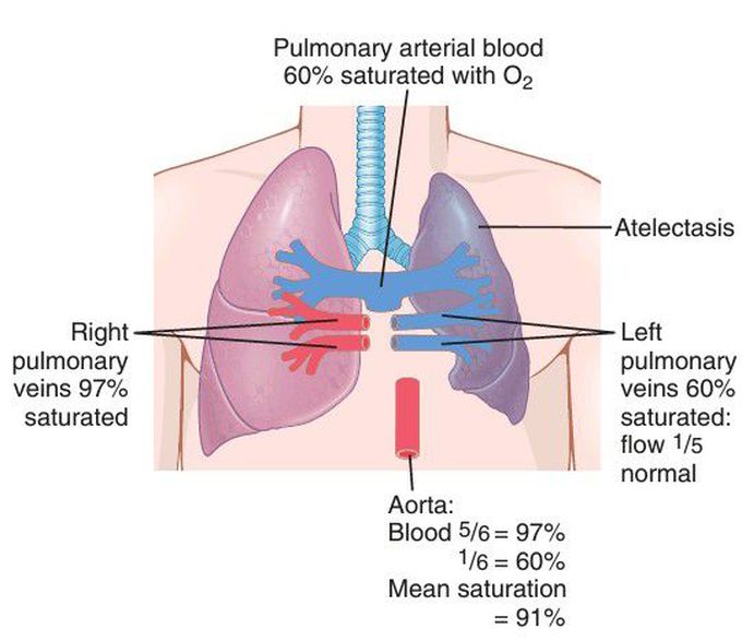 Atelectasis