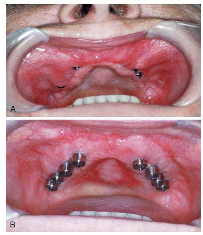 Maxillary vestibuloplasty with tissue grafting