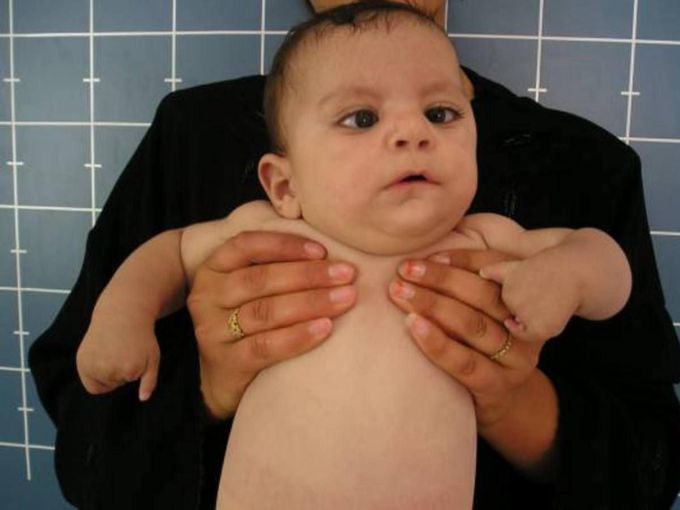 Moebius syndrome🤯