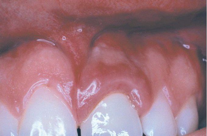 Granulomatous Gingivitis