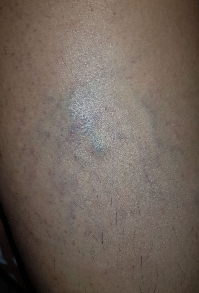 What does this closeness of the veins indicate??