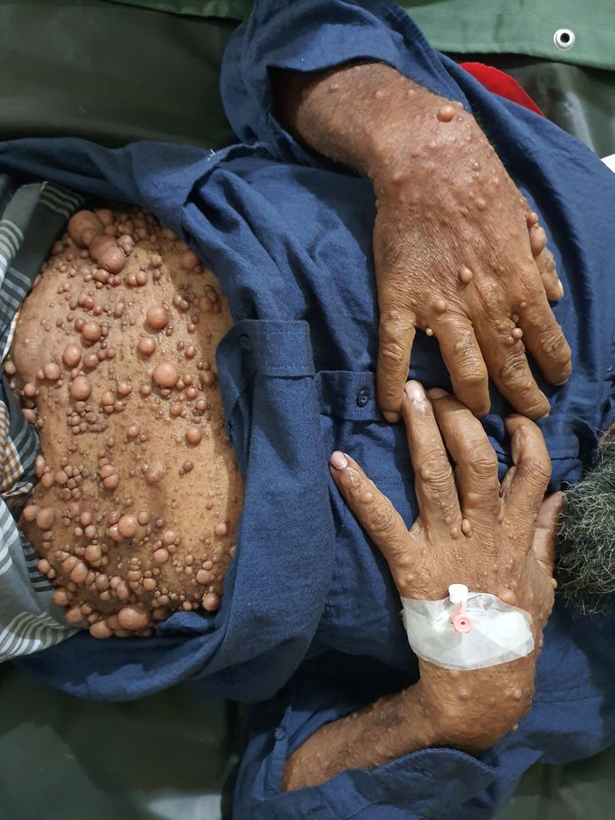 Neurofibromatosis