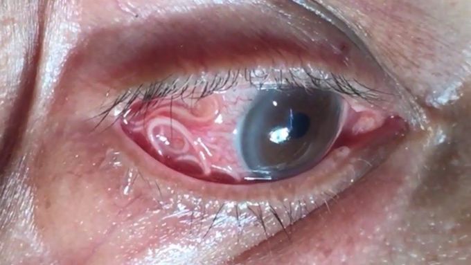 Hit a like here! Parasitic worm removed from Man's EYE