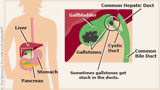 causes of cholelithiasis