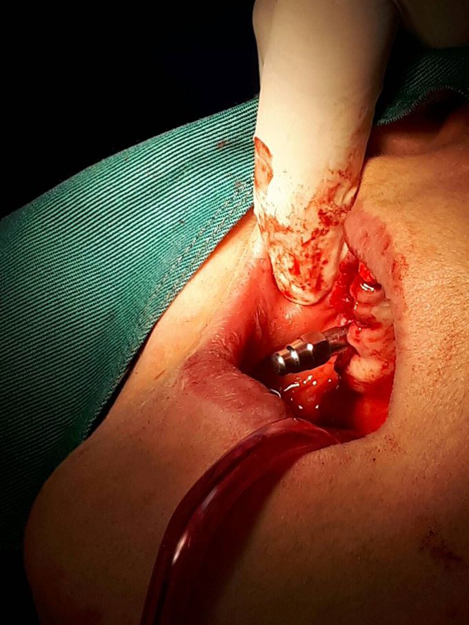 Dental implant surgery 😊