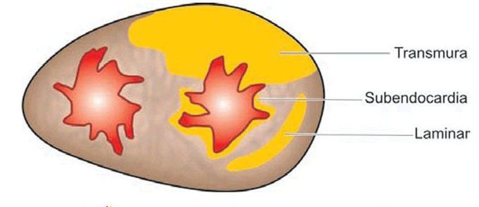 Extent of myocardial infarction