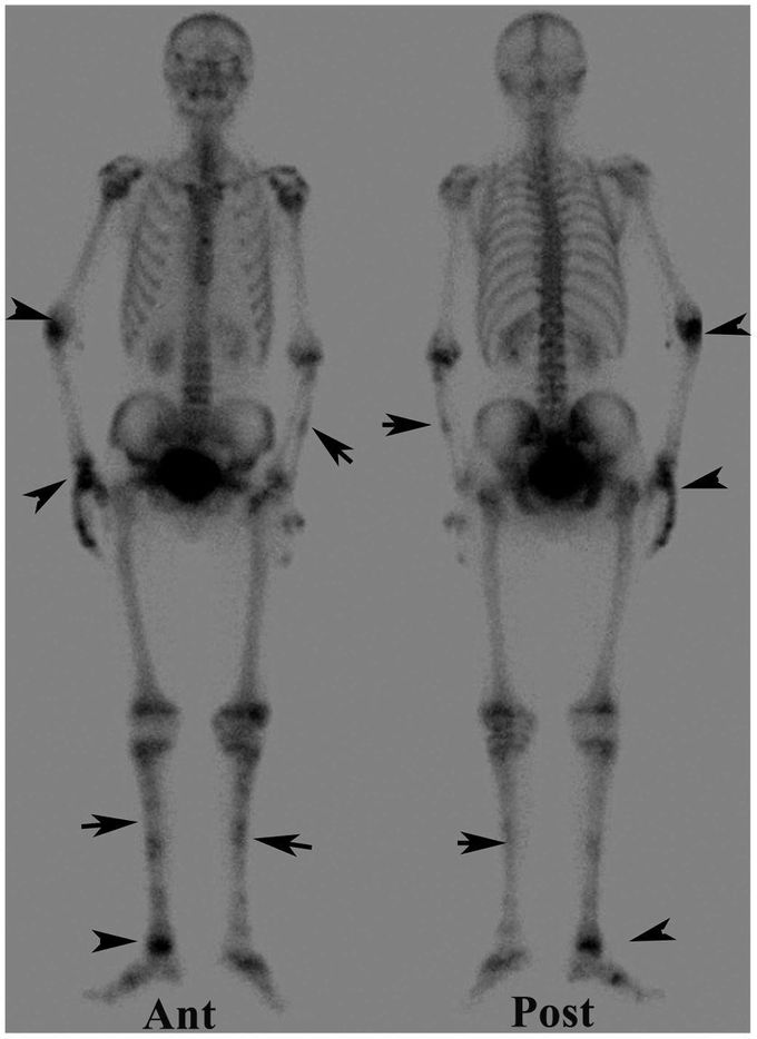 Skeletal Tuberculosis