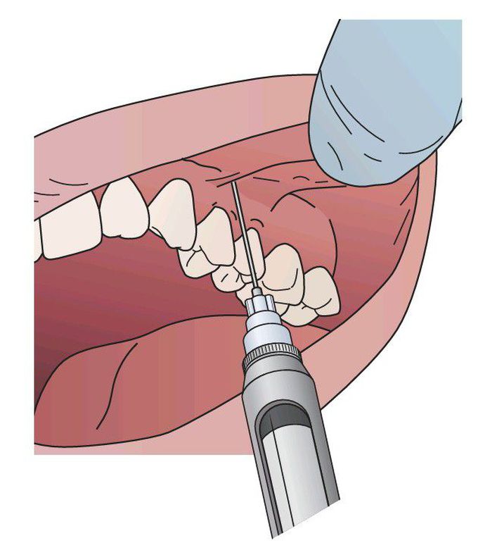 Technique for infiltrating near apices of individual teeth.