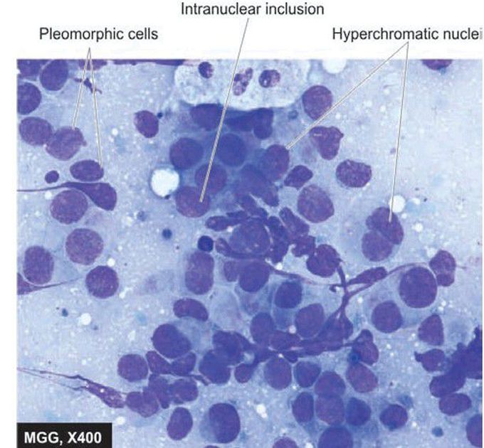 Ductal carcinoma.