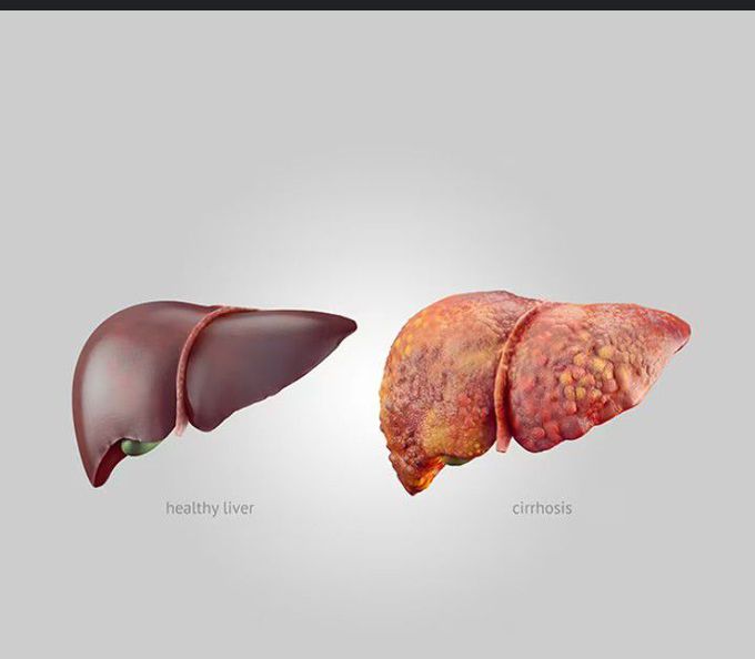 Liver cirrhosis