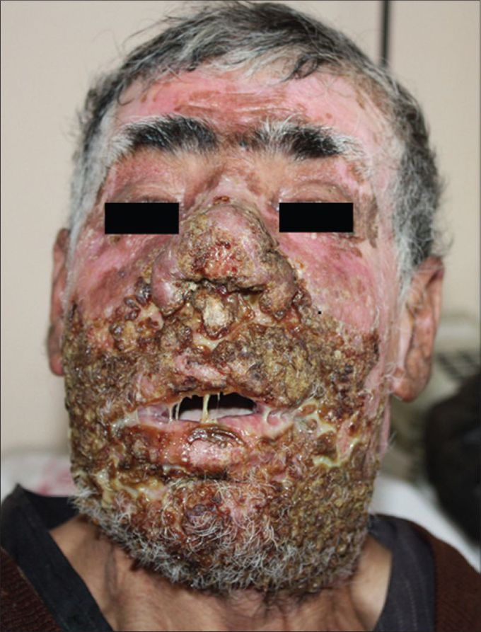 Mucocutaneous Leishmaniasis