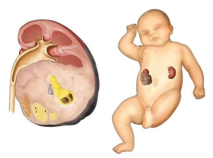 Causes of wilms tumor