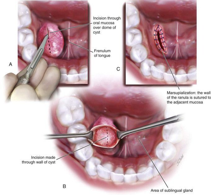 Ranula---Marsupialization