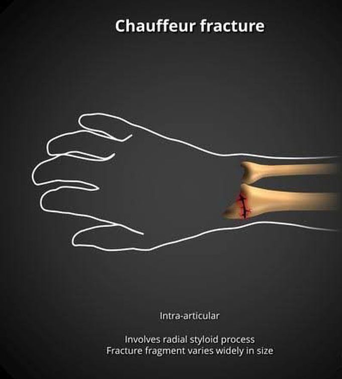 Chauffeur fracture