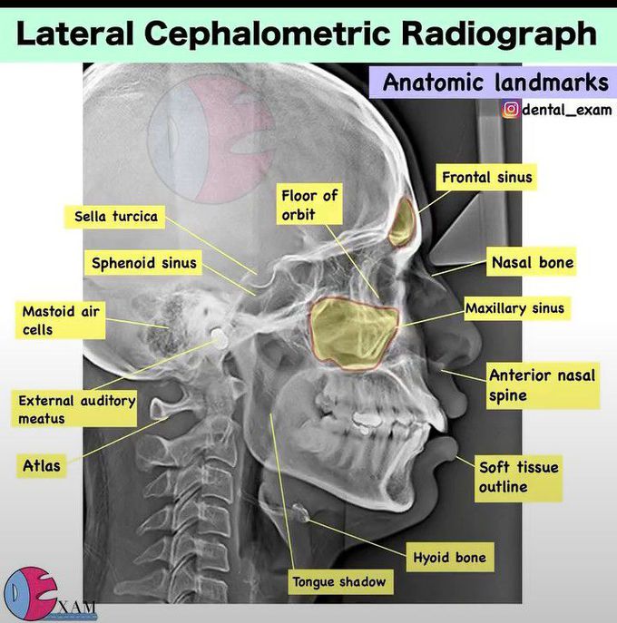 Lateral Cephalometric Radiograph
