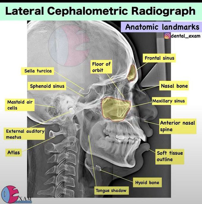 Lateral Cephalometric Radiograph
