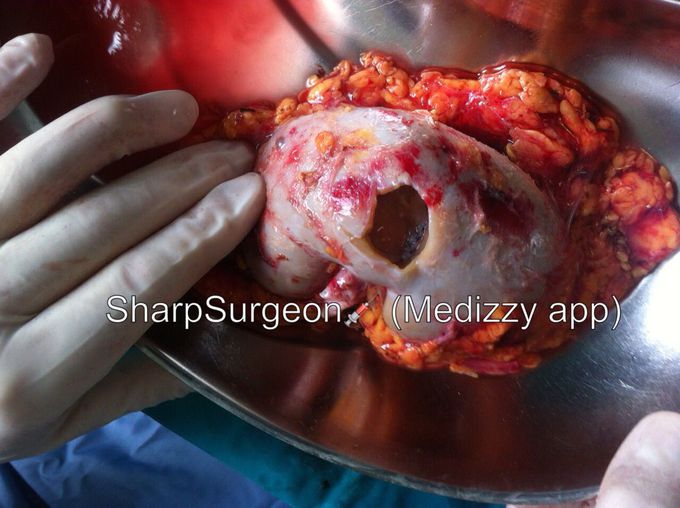 Kidney after tumor removal📍
